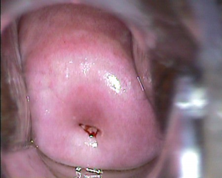 Citologías y colposcopia